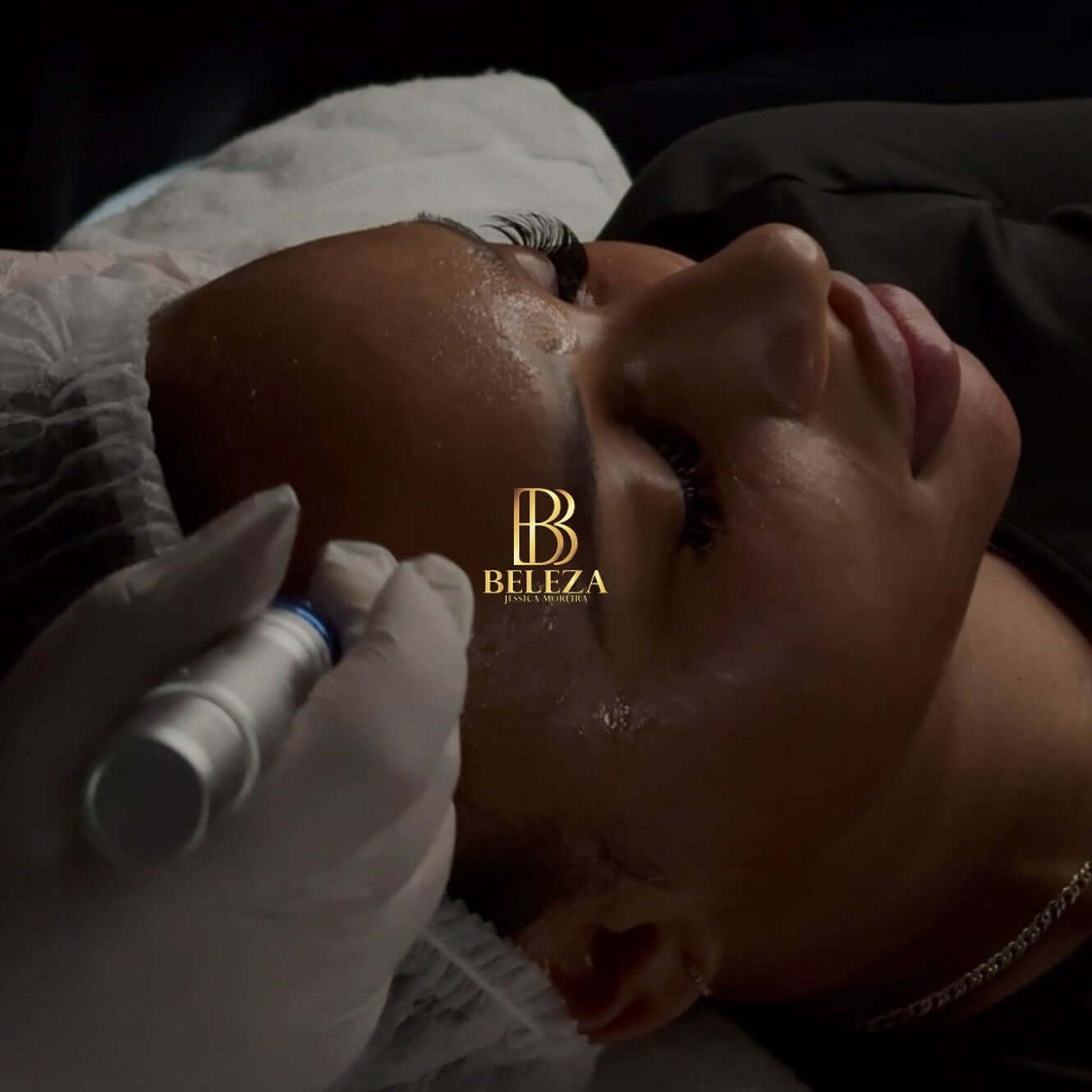 Luxury facial treatment in progress with microneedling at Beleza Spa, showcasing skincare expertise and rejuvenation.